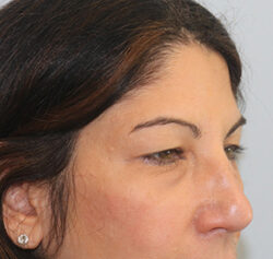 Blepharoplasty