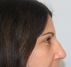 Blepharoplasty