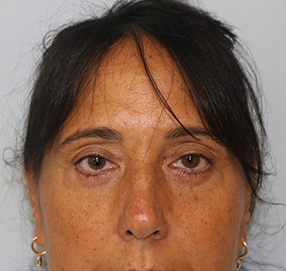 Blepharoplasty