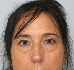 Blepharoplasty