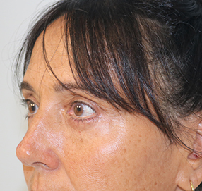 Blepharoplasty