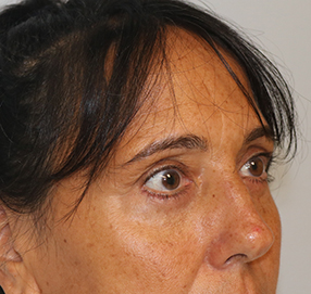 Blepharoplasty