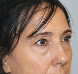 Blepharoplasty
