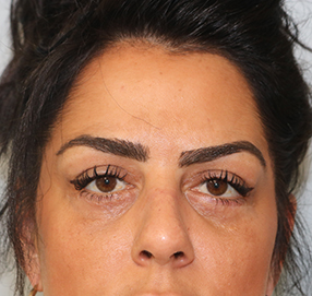Blepharoplasty