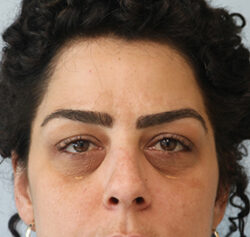 Blepharoplasty