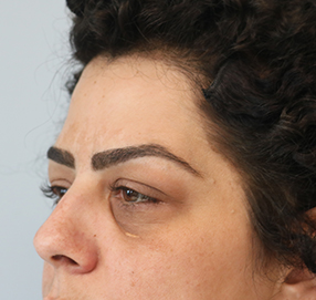 Blepharoplasty
