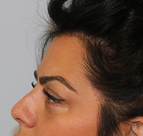 Blepharoplasty