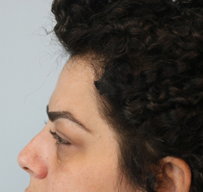 Blepharoplasty