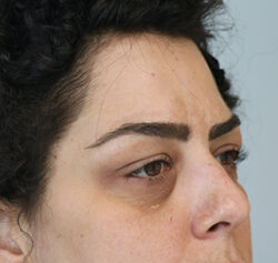 Blepharoplasty