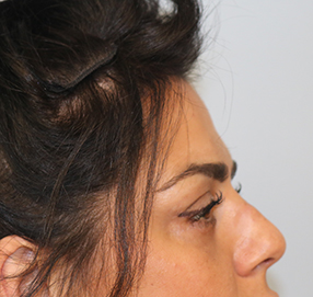 Blepharoplasty