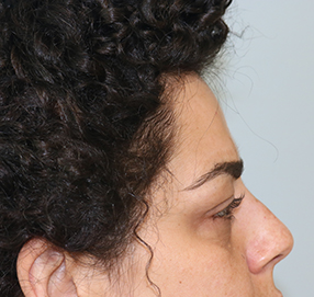 Blepharoplasty