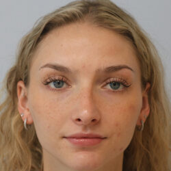 Rhinoplasty