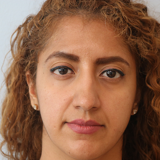 Rhinoplasty