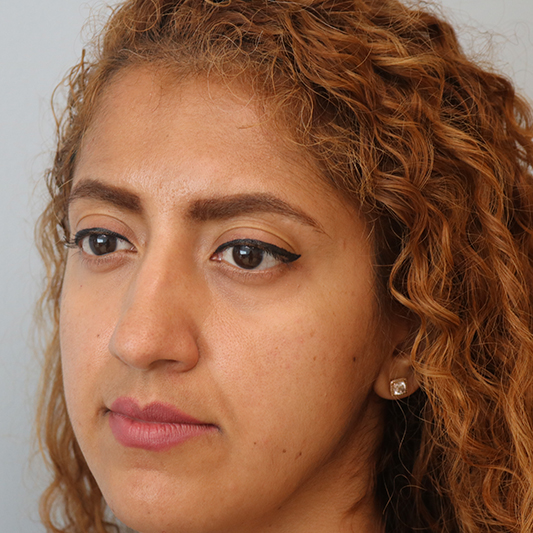Rhinoplasty