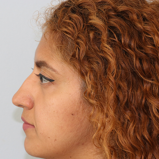 Rhinoplasty