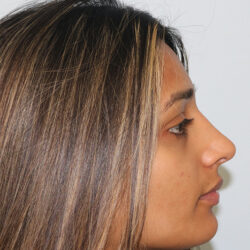 Rhinoplasty