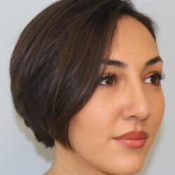 Rhinoplasty