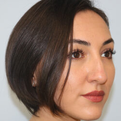 Rhinoplasty