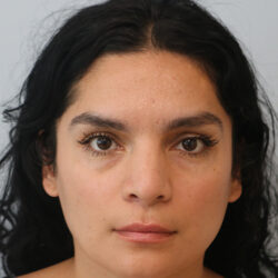Rhinoplasty